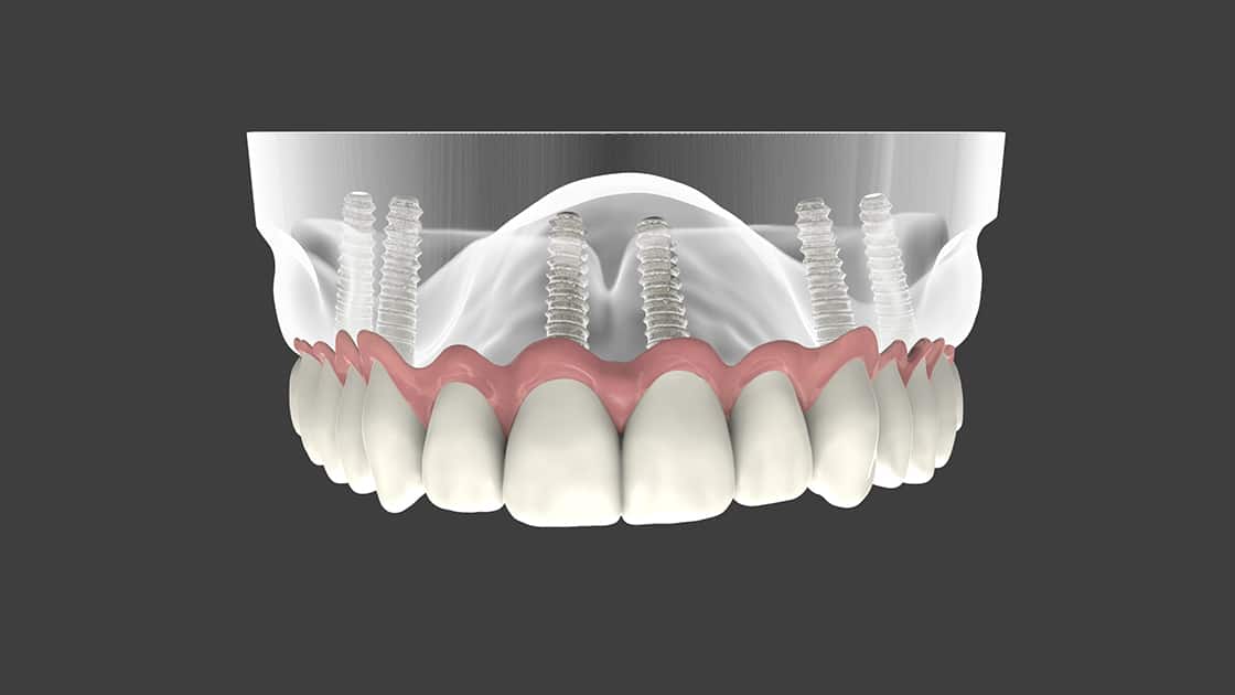 Mini Dental Implants