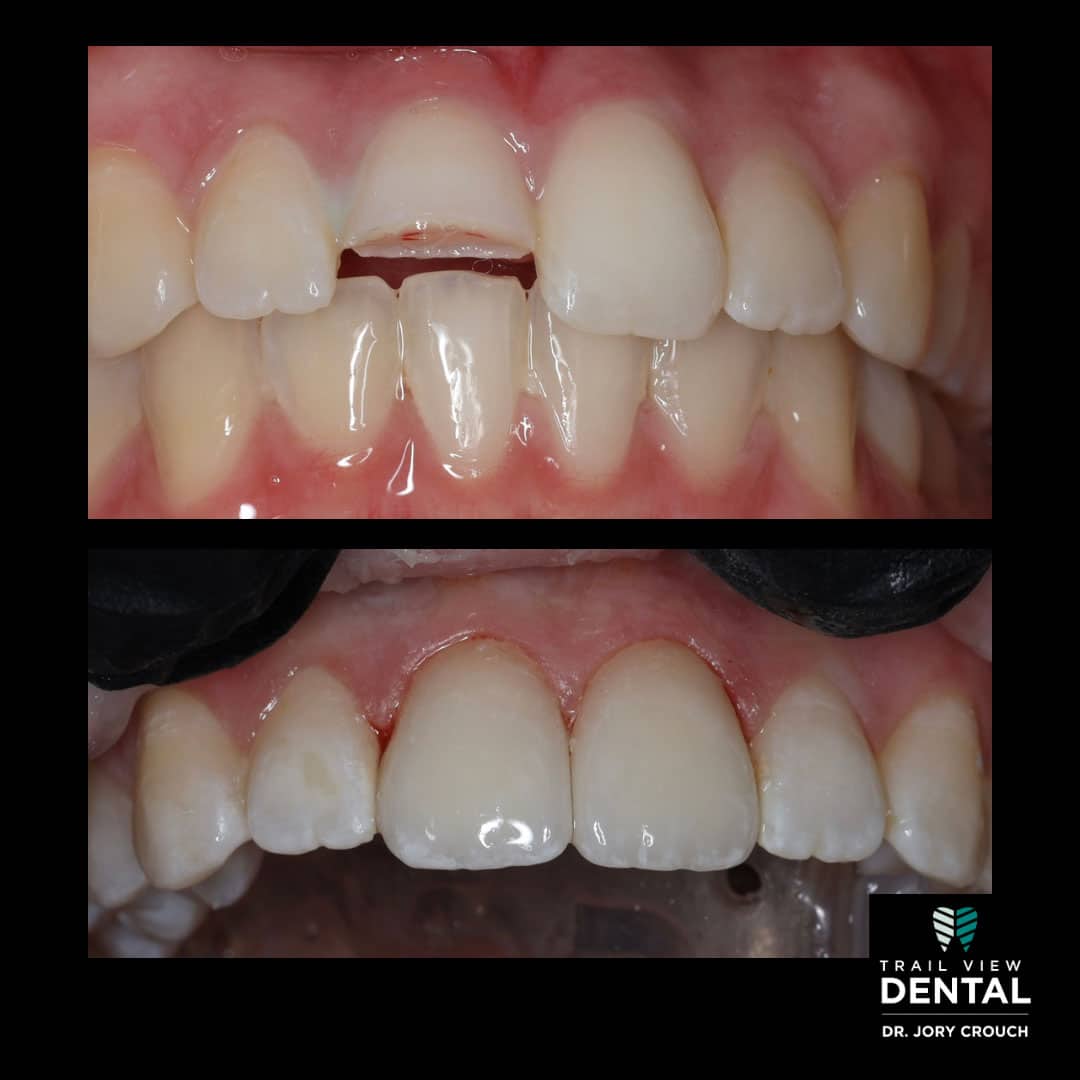 Veneers Crowns Teeth